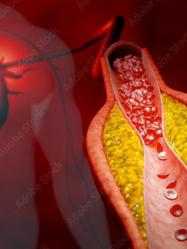 Cholesterol