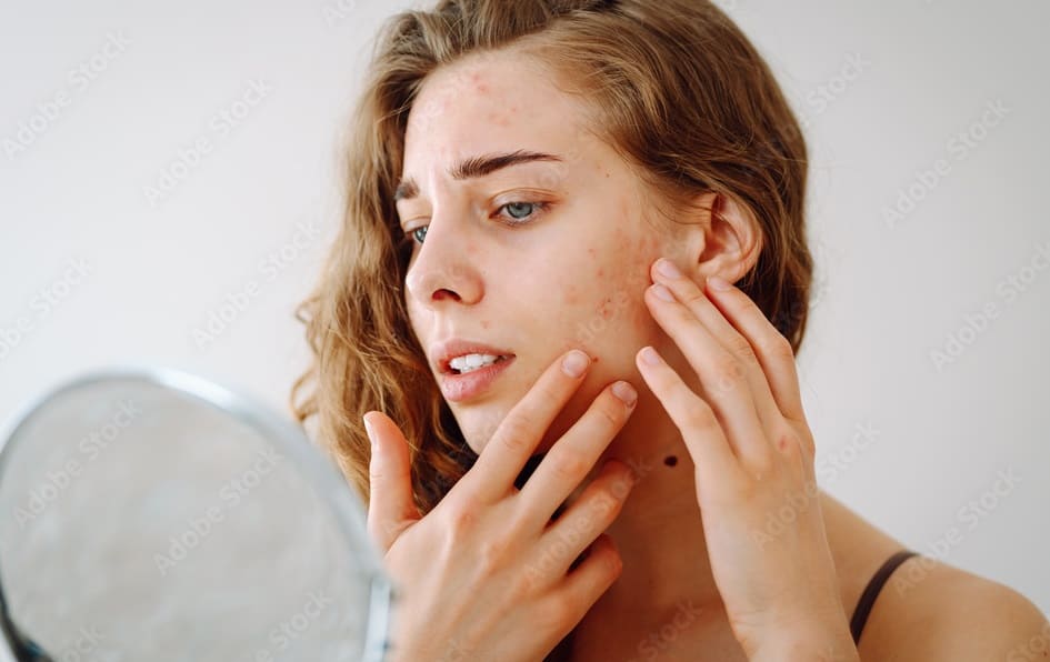 How Stress Affects Your Skin and What to Do About It - Myhealthopedia