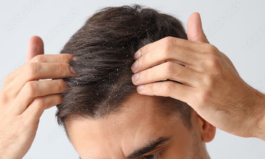 Apple Cider Vinegar to Reduce Dandruff