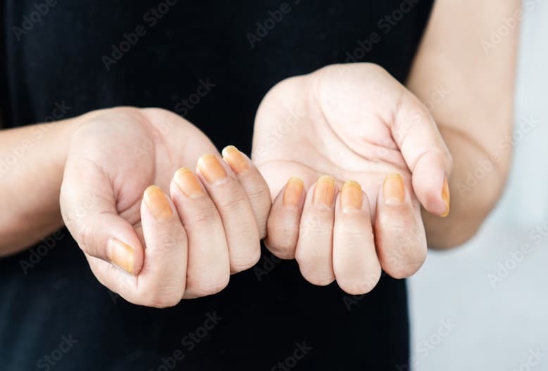 Clean Yellow Nails