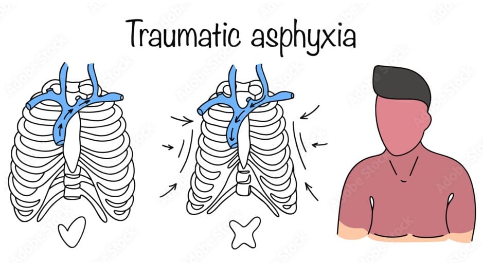 Traumatic Asphyxia