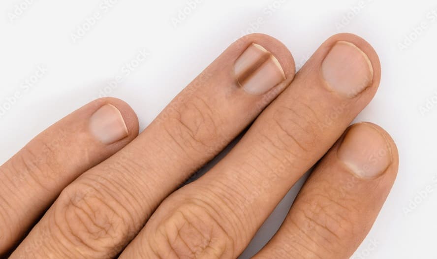 Black Line on the Nail
