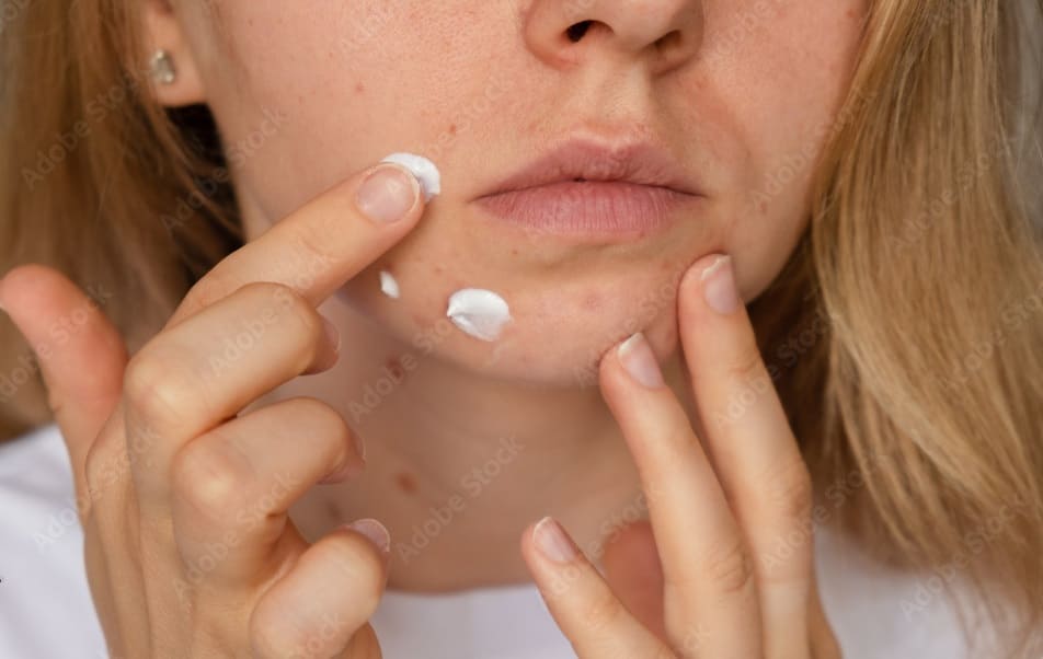 Toothpaste on Pimples