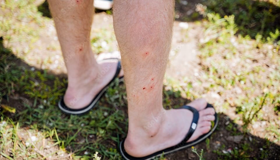 Gnat Bites