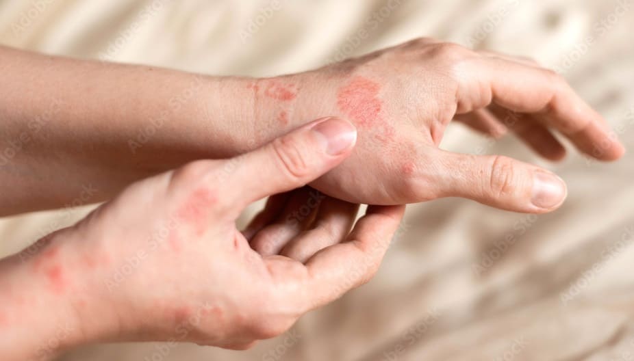 Eczema
