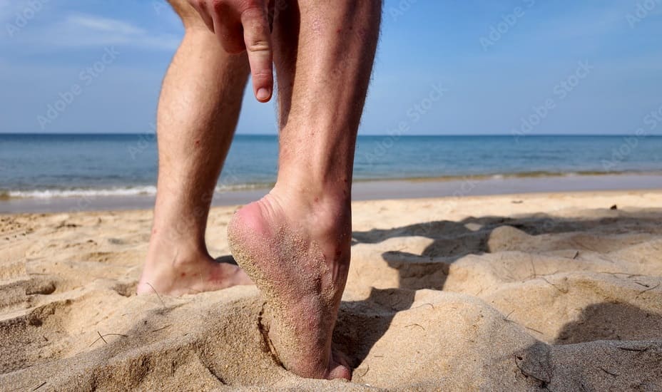 Sand Flea Bites