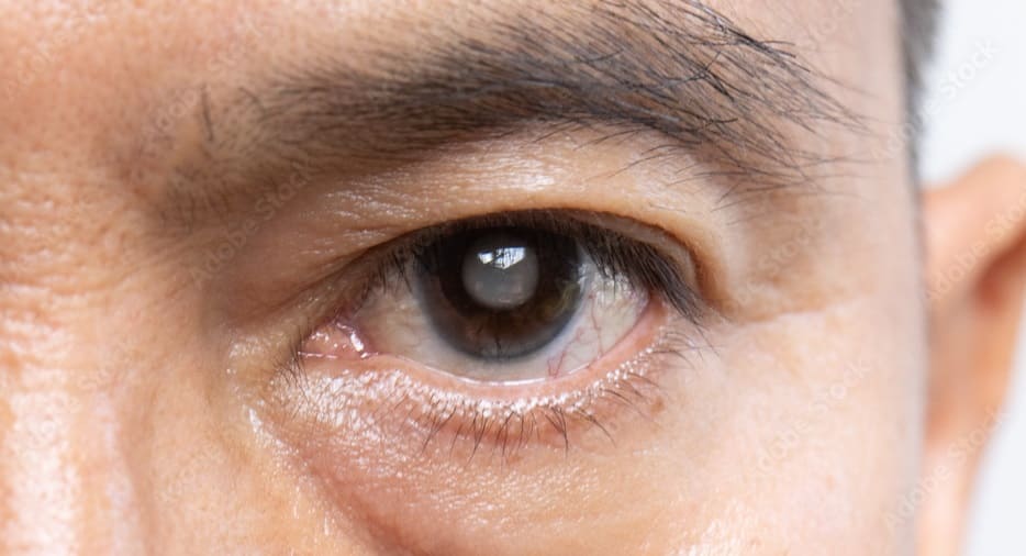 Cataracts