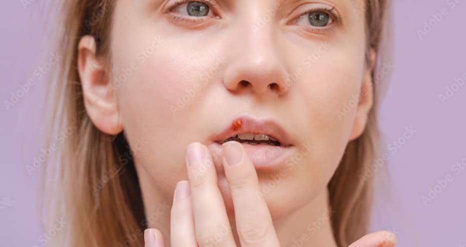Lip Pimples