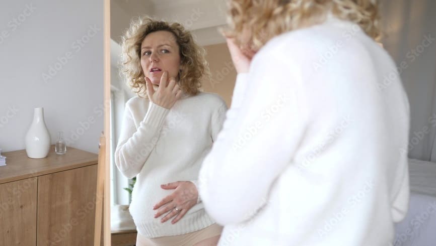 Pregnancy Acne