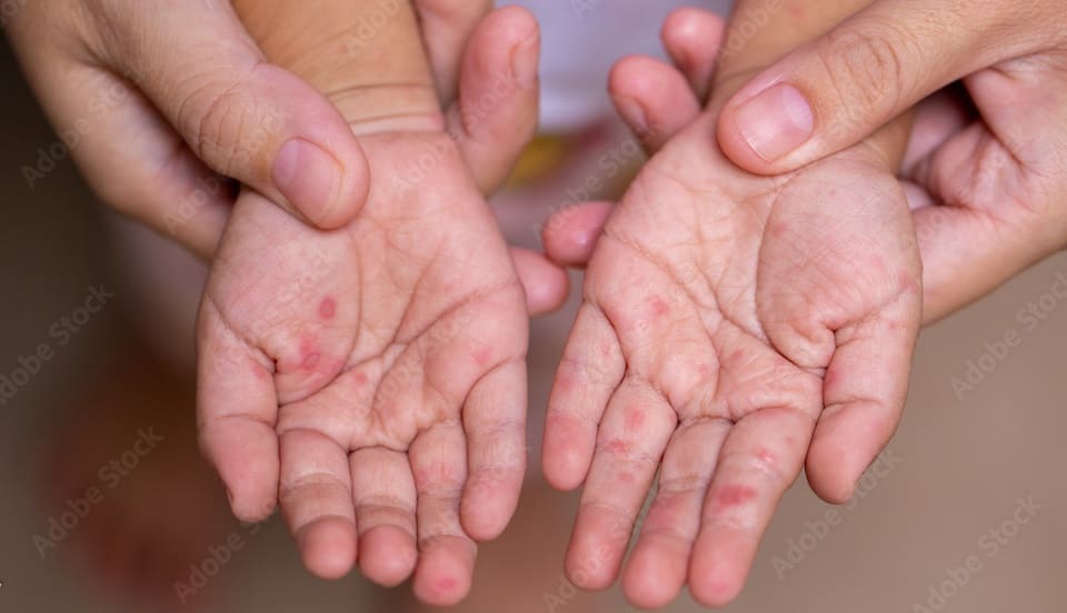 Hand, Foot and Mouth Disease