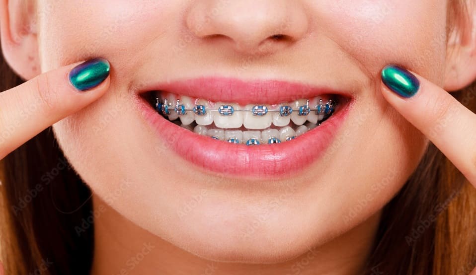 Teeth Braces