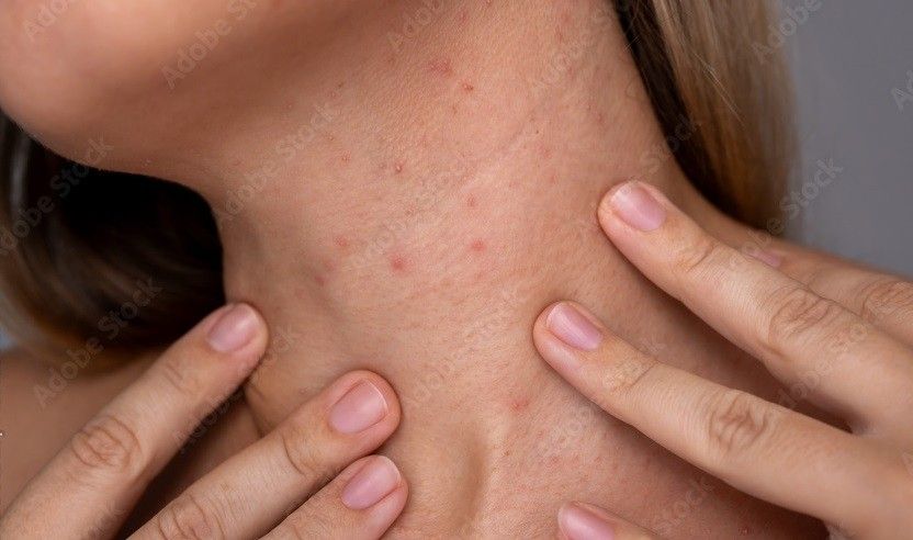Neck Acne