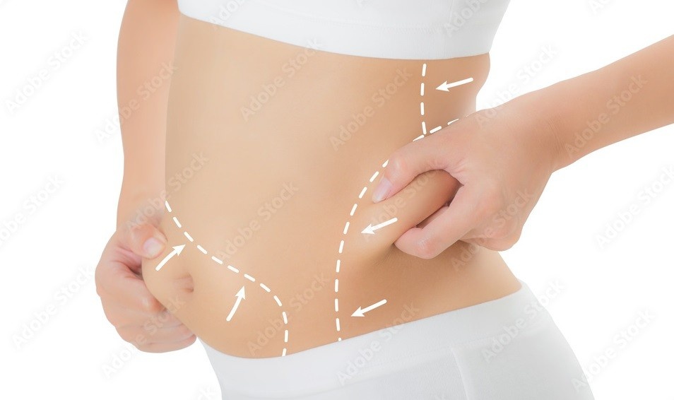 Liposuction