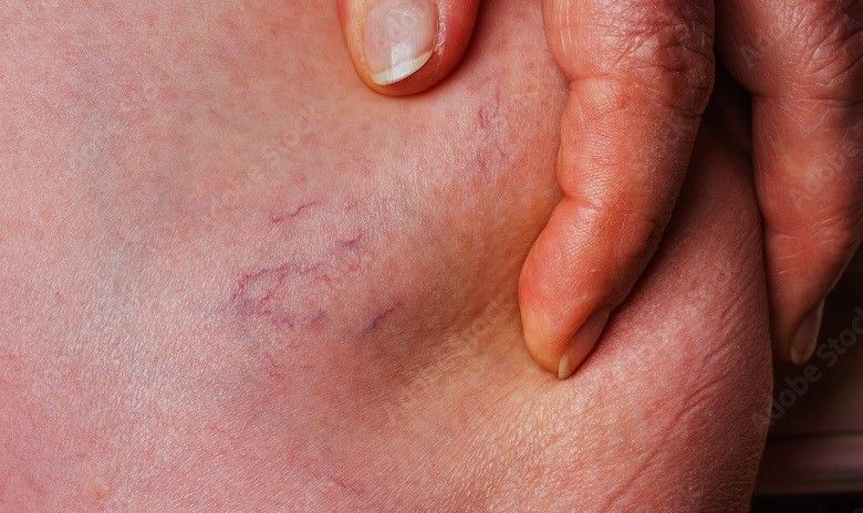 Spider Angioma