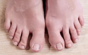 What Thick Toenails Indicate? Causes, Symptoms & Treatments