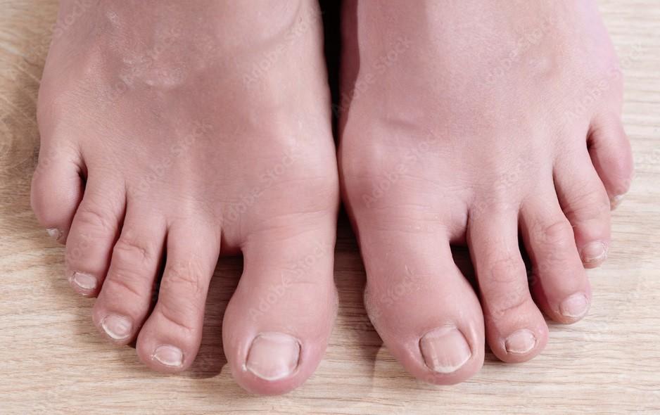Thick Toenails