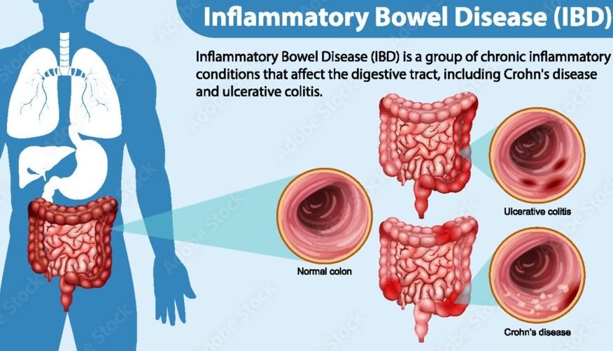 Inflammatory Bowel Disease