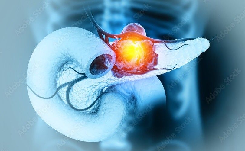Pancreatic Cancer