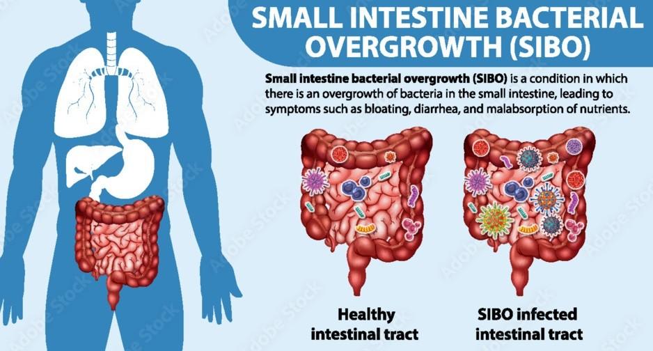 SIBO