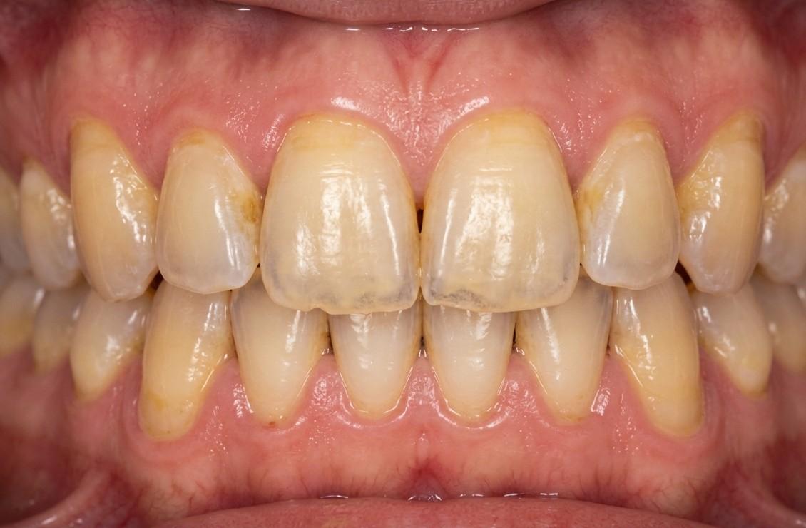 Tooth Erosion